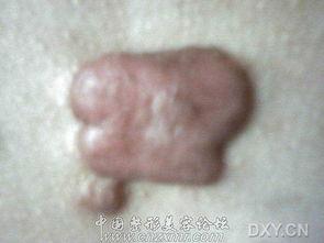 泛疙瘩图片,探寻肌肤纹理之美